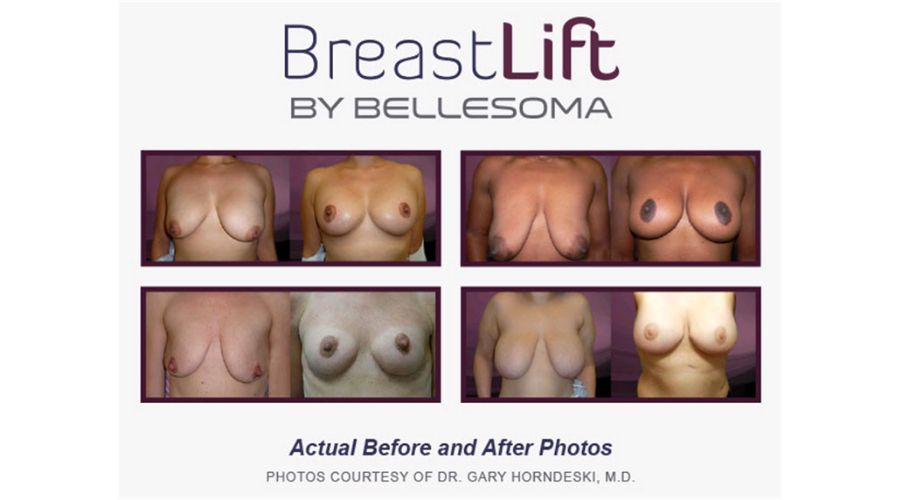 傷の残らない特殊な乳房リフト手術法「ベレソマリフト」