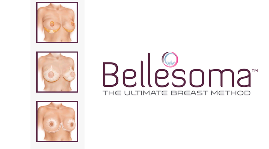 「ベレソマ乳房リフト」Bellesoma™ Breast Lift とは？