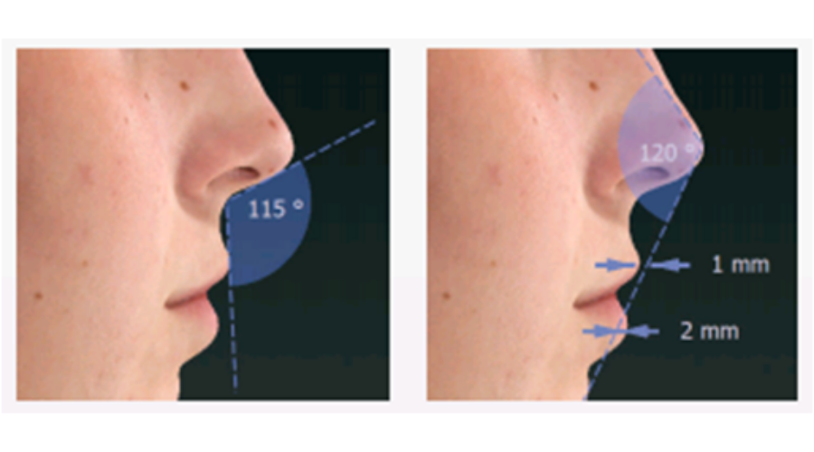 3Dシミュレーションによるオーダーメイドの鼻整形