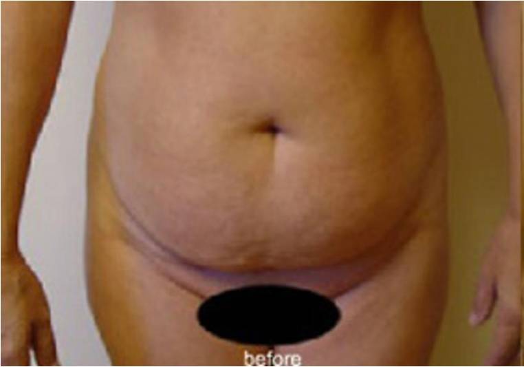 腹壁形成手術タミータック ハワイ アジアパシフィック美容整形外科