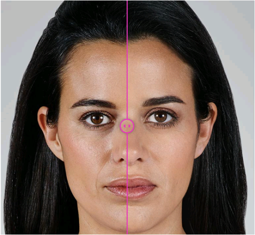 ヒアルロン酸の顔の適応部位