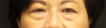 目の上のまぶたのたるみ取り ハワイ アジアパシフィック美容整形外科