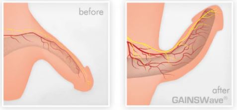 ＥＤ治療（GainsWave低出力衝撃波治療）