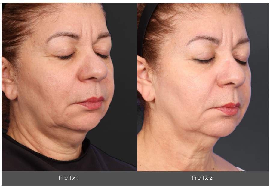 痛みを抑えた快適RF治療